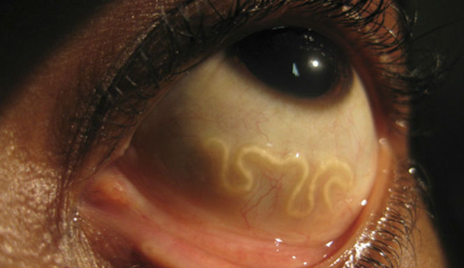 pork tapeworm in eye